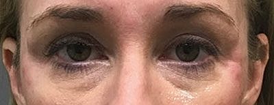 Fillers Before & After