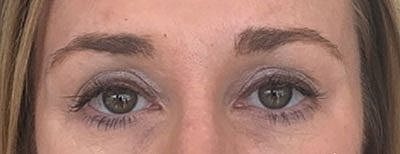 Fillers Before & After