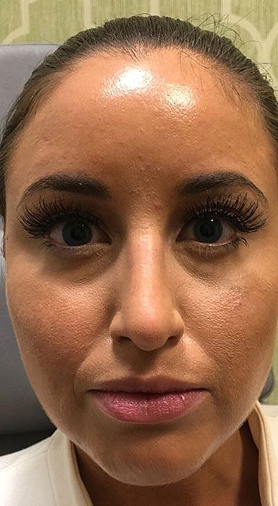 Fillers Before & After