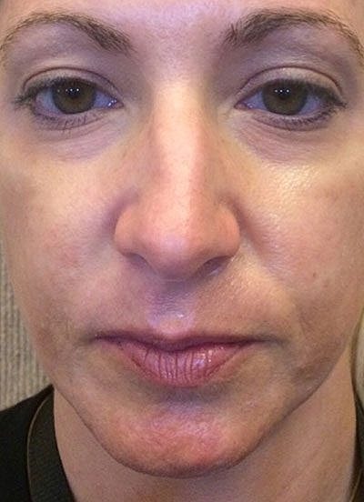 Fillers Before & After