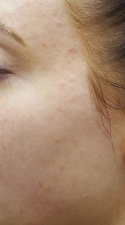 Fillers Before & After