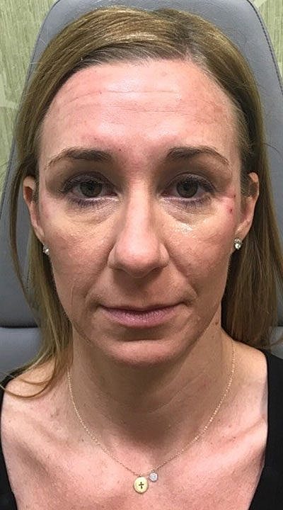 Fillers Before & After