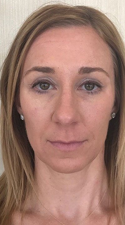 Fillers Before & After