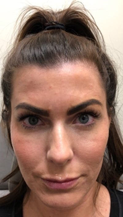 Cheek Filler Before & After