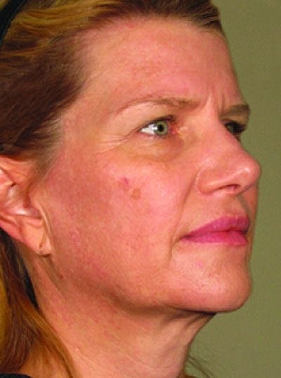 Ultherapy Before & After