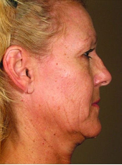 Ultherapy Before & After