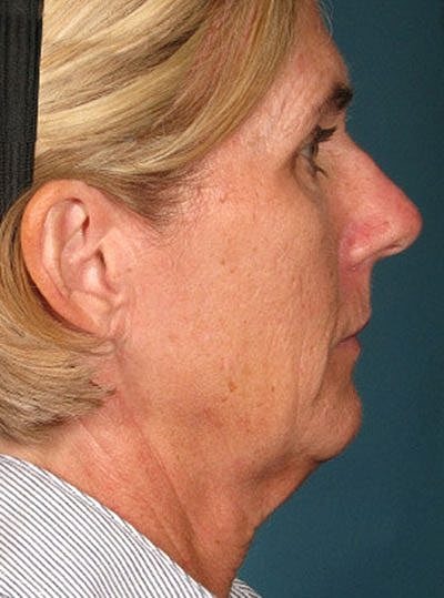 Ultherapy Before & After