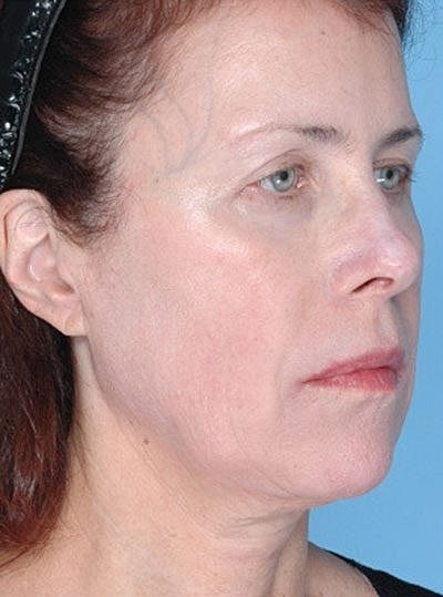 Ultherapy Before & After