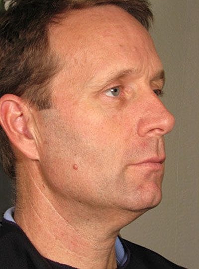 Ultherapy Before & After