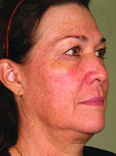 Ultherapy Before & After