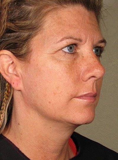 Ultherapy Before & After