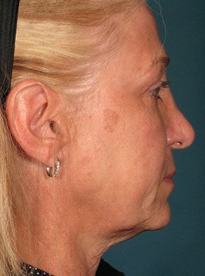 Ultherapy Before & After