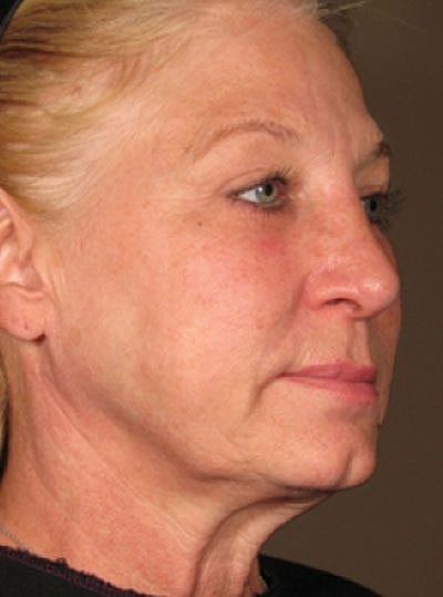 Ultherapy Before & After