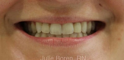 Lip Filler Before & After