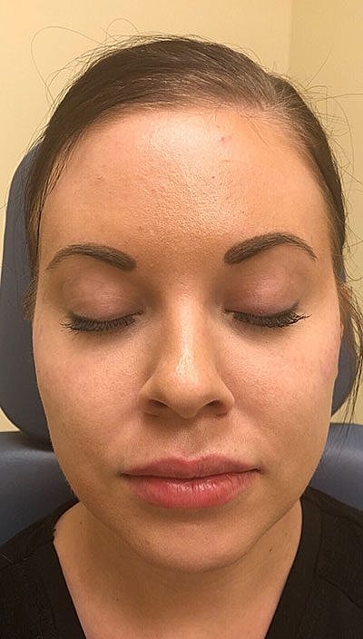 Lip Filler Before & After