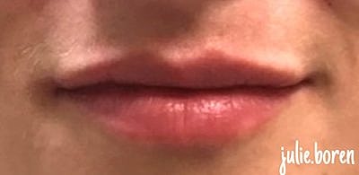 Lip Filler Before & After