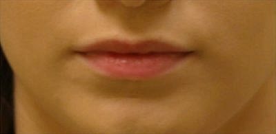 Lip Filler Before & After