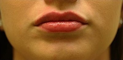 Lip Filler Before & After