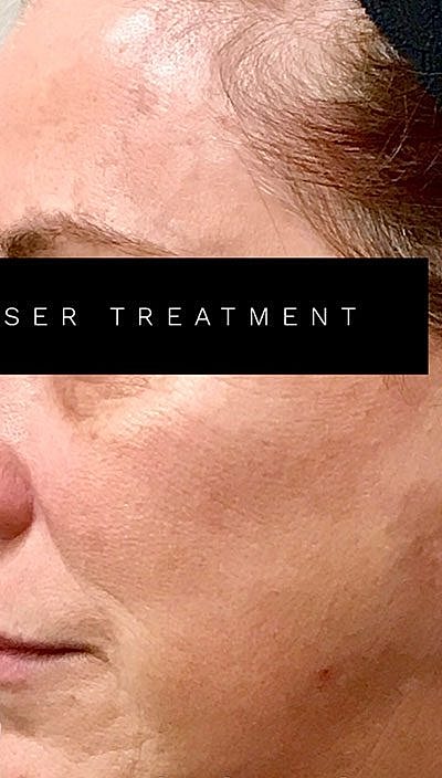 Laser Before & After