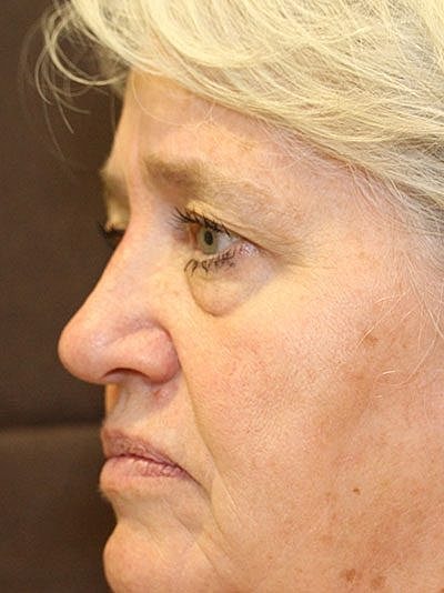 Botox Before & After