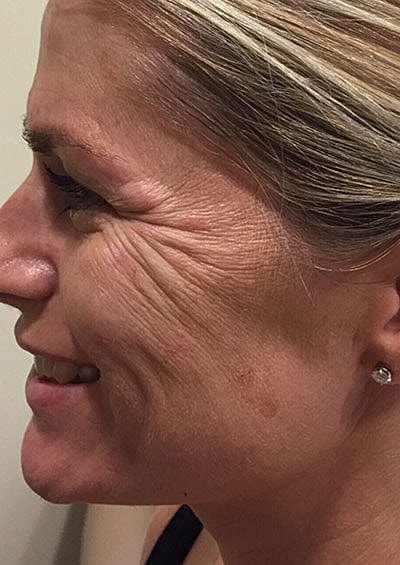 Botox Before & After