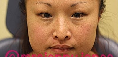 Tear Trough Filler Before & After