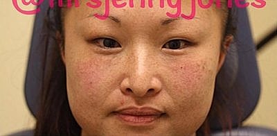 Tear Trough Filler Before & After