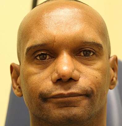 Tear Trough Filler Before & After