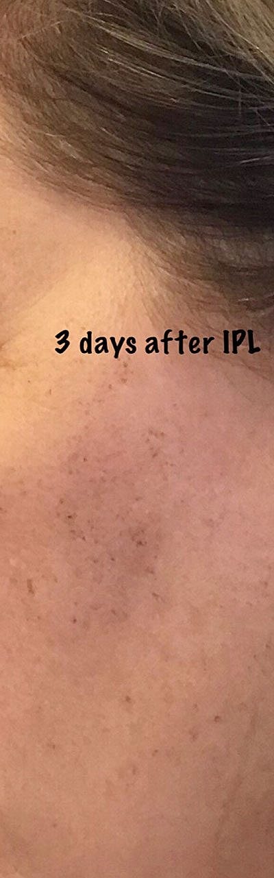 Ipl Before & After