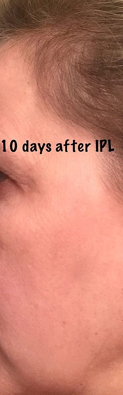 Ipl Before & After
