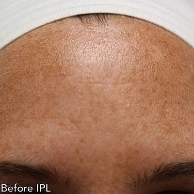 Ipl Before & After